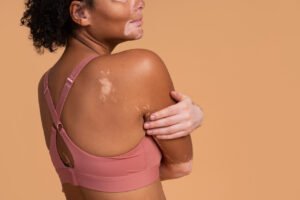 Conozca más del vitiligo