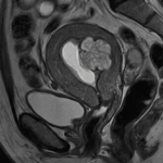 Cáncer de Endometrio: el segundo más frecuente entre los cánceres ginecológicos