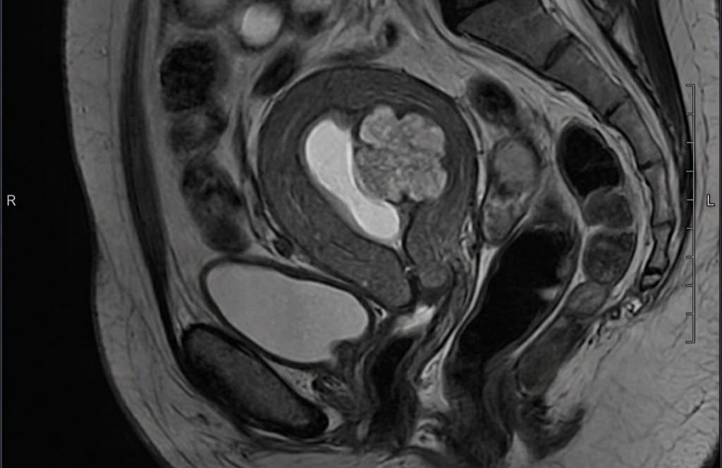 Cáncer de Endometrio: el segundo más frecuente entre los cánceres ginecológicos